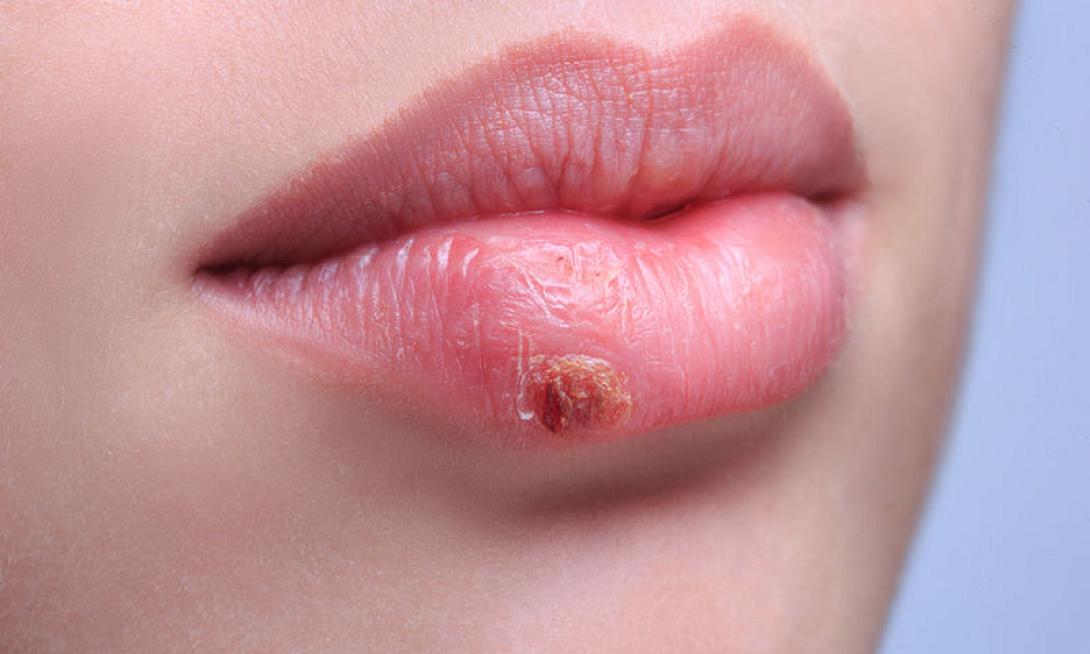 bigstock-beautiful-lips-virus-infected-79990079.jpg