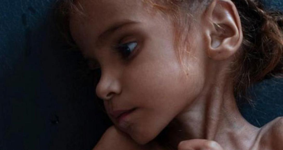 Υεμένη - Λιμός