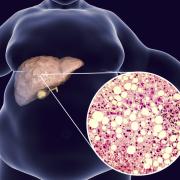 Λιπώδης νόσος του ήπατος