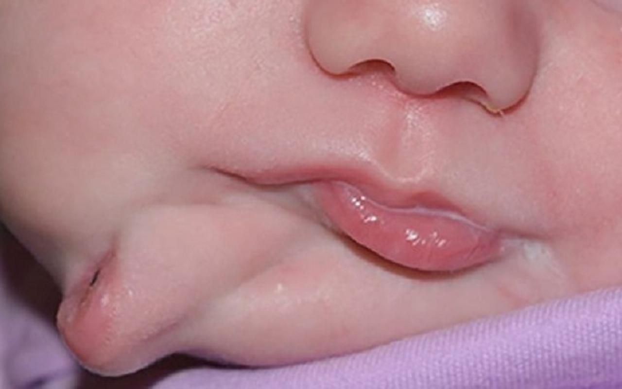 Το μωρό γεννήθηκε με δεύτερο στόμα!