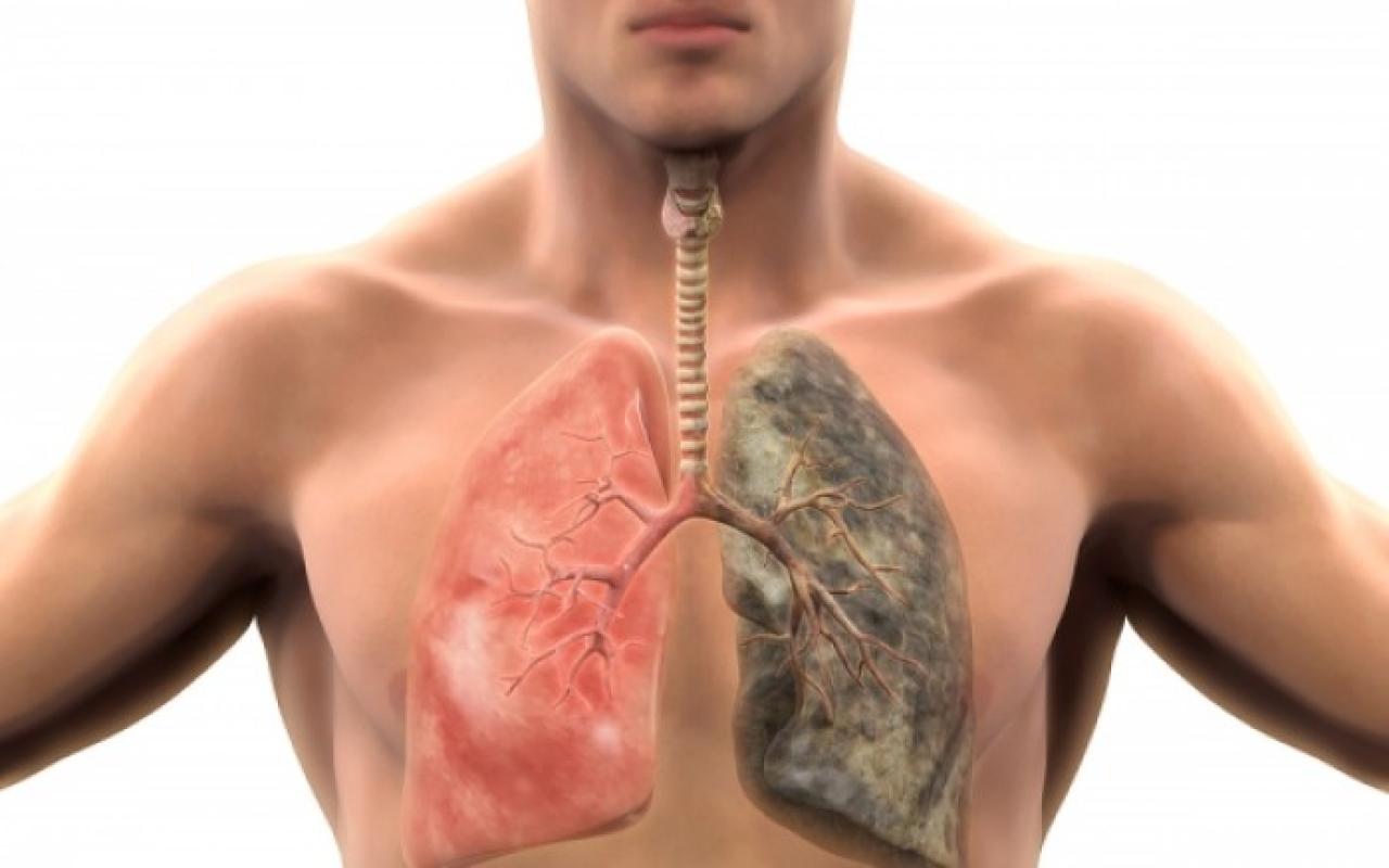 καρκίνος του πνεύμονα.jpg