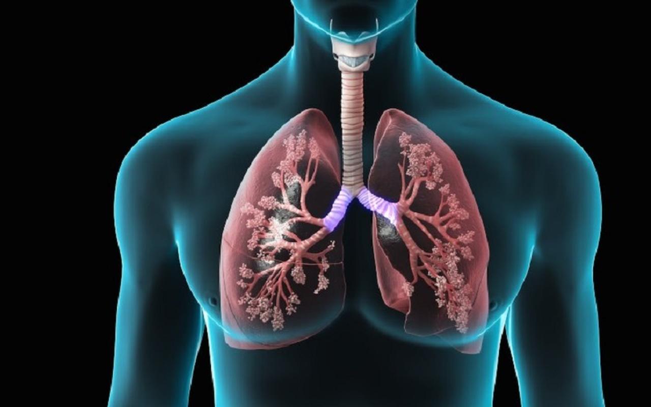 Καρκίνος πνεύμονα