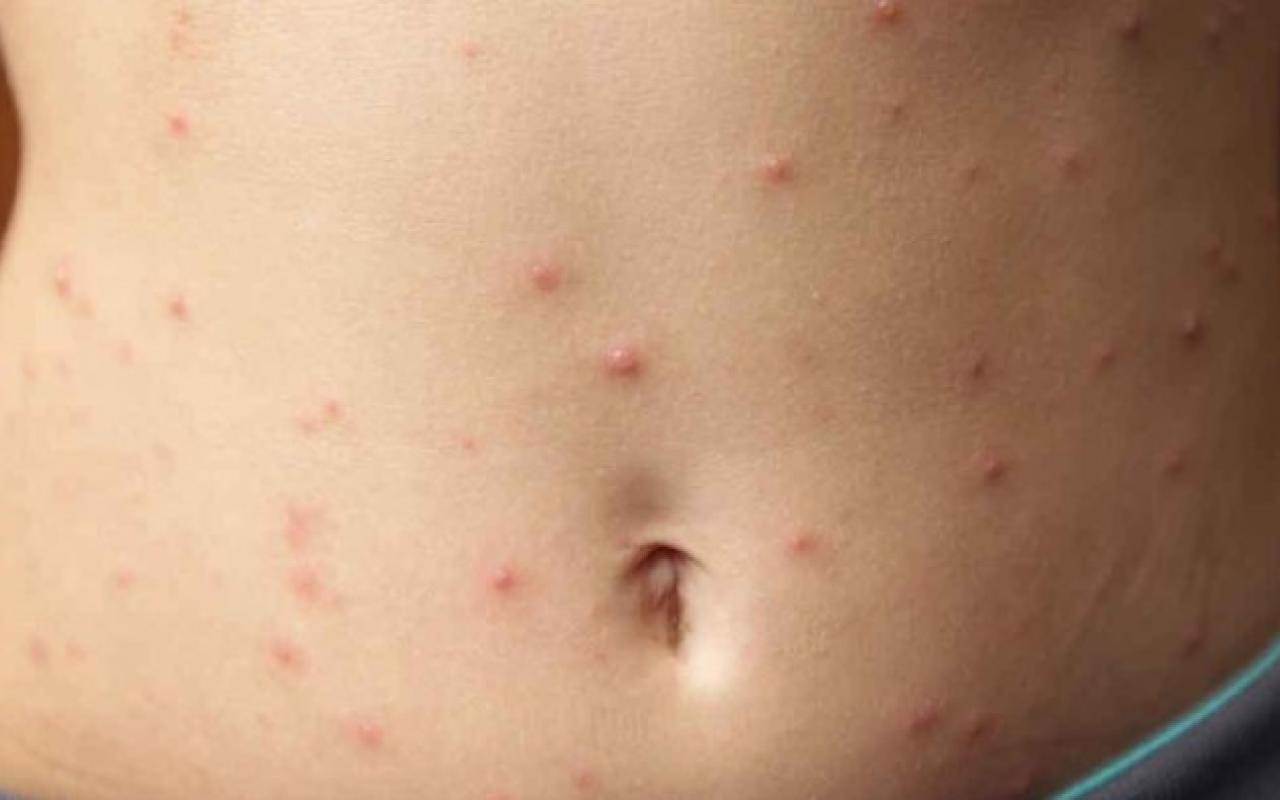 measles-adult.jpg