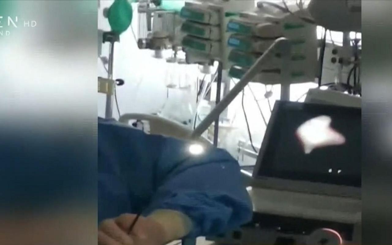  γιατροί έσωσαν μωρό που κατάπιε καρύδι 