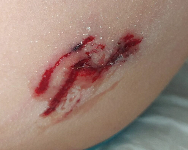 σκύλος δάγκωμα