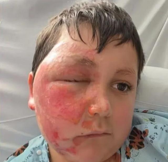 9χρονος εγκαυματίας ηπα