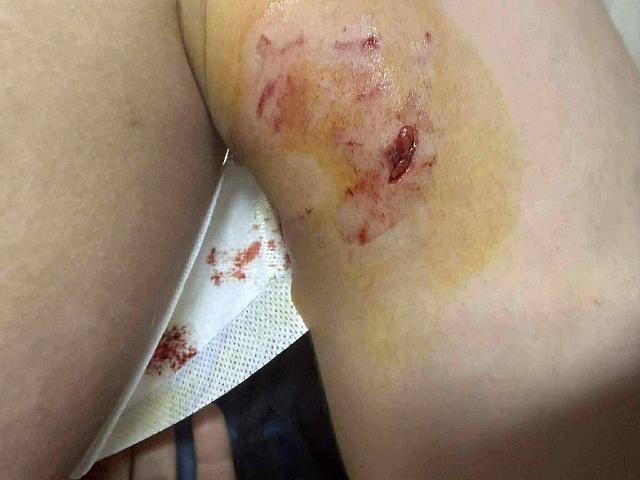 επιθεση σκυλου