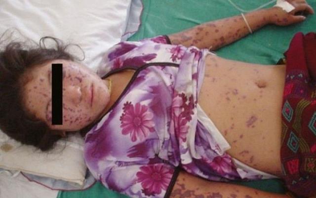 &nbsp;Λεπτοσπείρωση