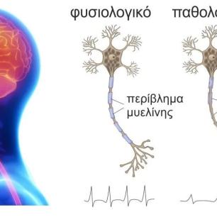 σκλήρυνση κατά πλάκας