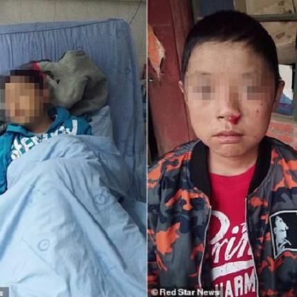 12χρονος έγινε «Δράκουλας»: Δεν μπορεί να δει ήλιο και αιμορραγεί από τα μάτια.jpg