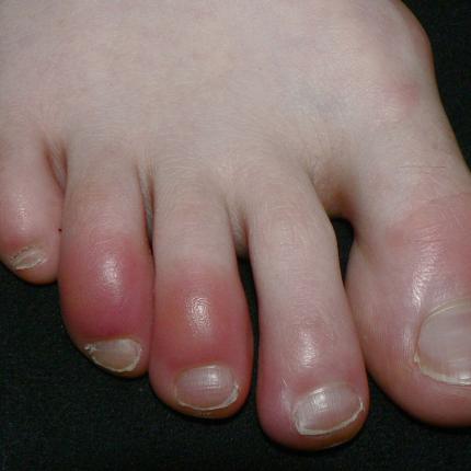 φουσκαλες ποδι