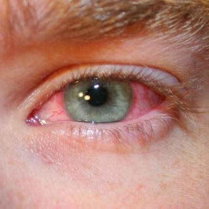 επιπεφυκιτιδα