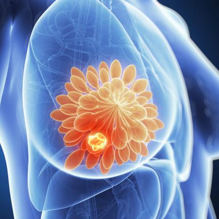 καρκινος μαστου