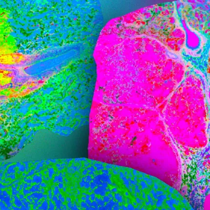 καρκίνος του πνεύμονα