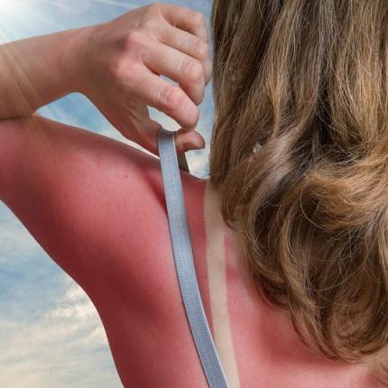 ηλιακή δηλητηρίαση