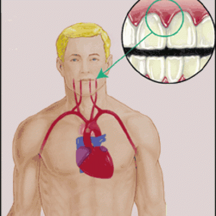 Η περιδοντίτιδα και η ουλίτιδα, &quot;σήμα&quot; για καρδιοπάθεια