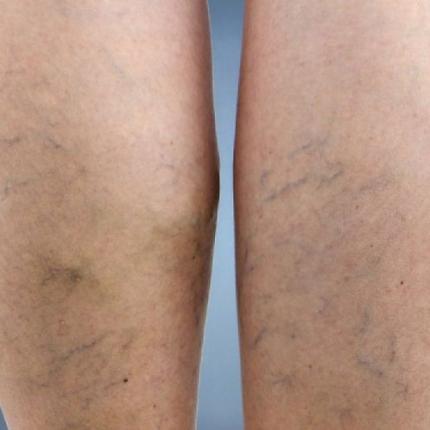 φλεβική θρόμβωση