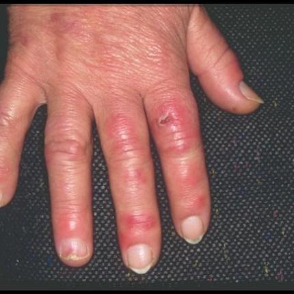 χιονίστρες