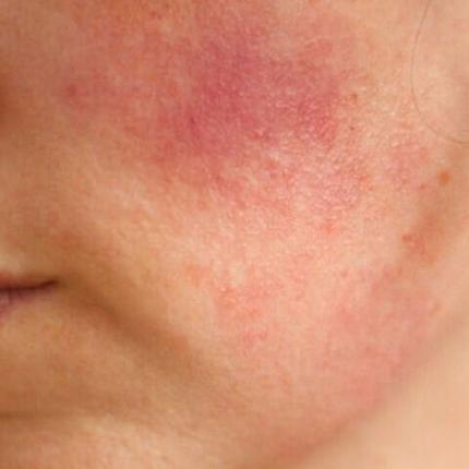 Ερυθηματώδης Λύκος