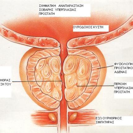 προστάτης