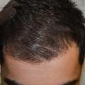 after-hair-implantation1.jpg