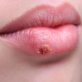 bigstock-beautiful-lips-virus-infected-79990079.jpg