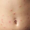 measles-adult.jpg