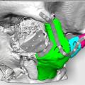 Εκτυπωτής 3D θα αποκαταστήσει πρόσωπο τραυματισμένου άνδρα.