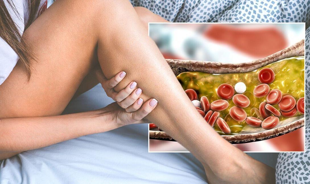 χοληστερόλη πόδια