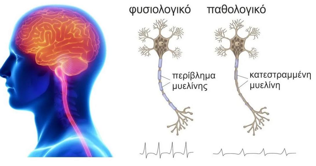 σκλήρυνση κατά πλάκας