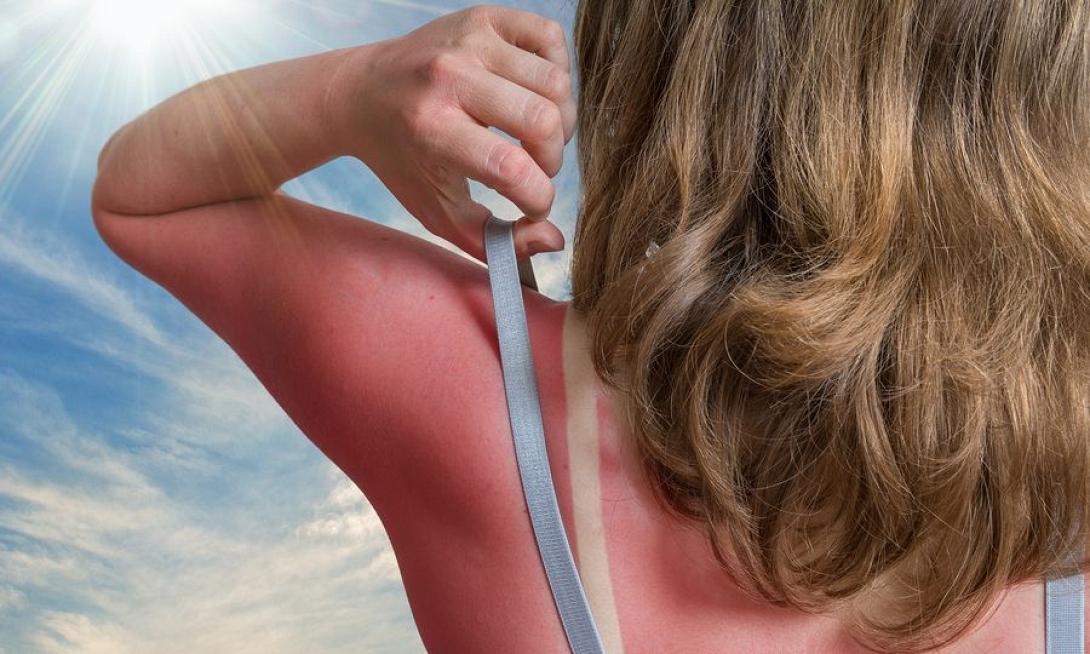 ηλιακή δηλητηρίαση