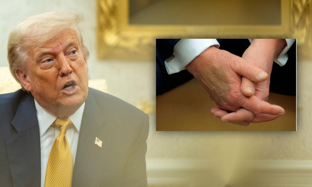 τραμπ μελανιές