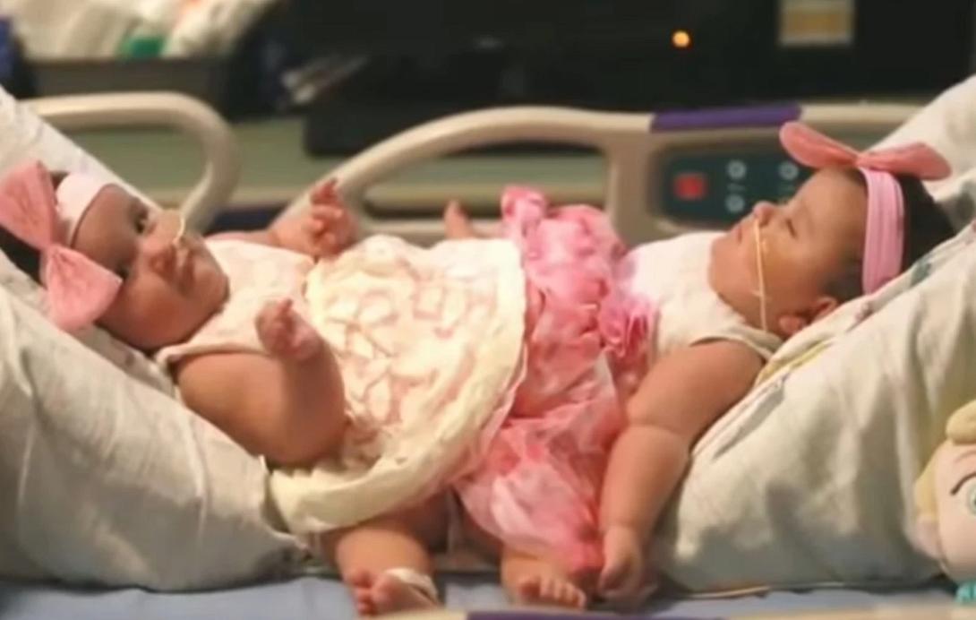 αδερφές, σιαμαίες