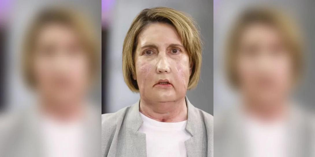 μεταμόσχευση, ισπανία