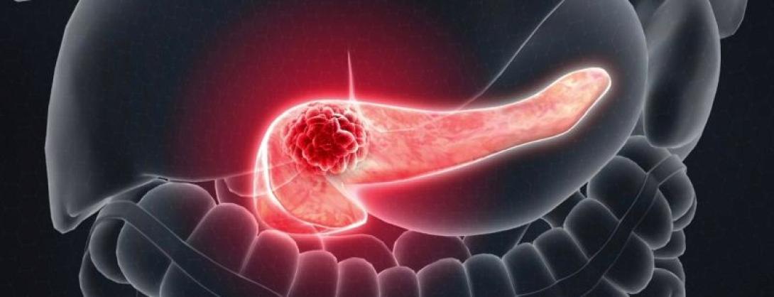 καρκίνος πάγκρεας