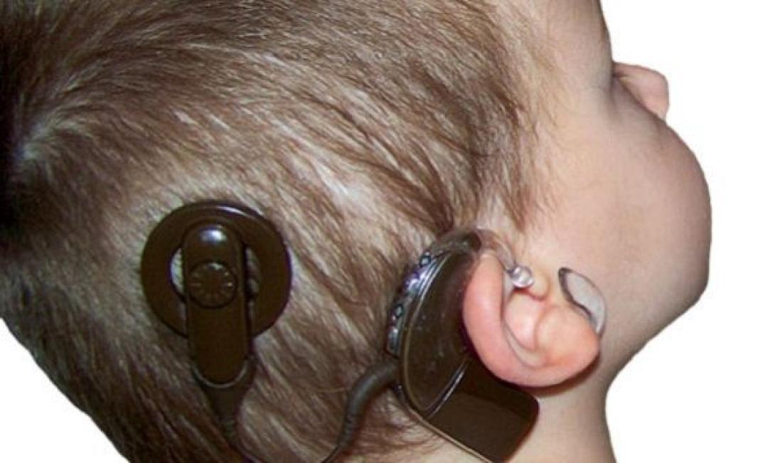 κοχλιακό εμφύτευμα