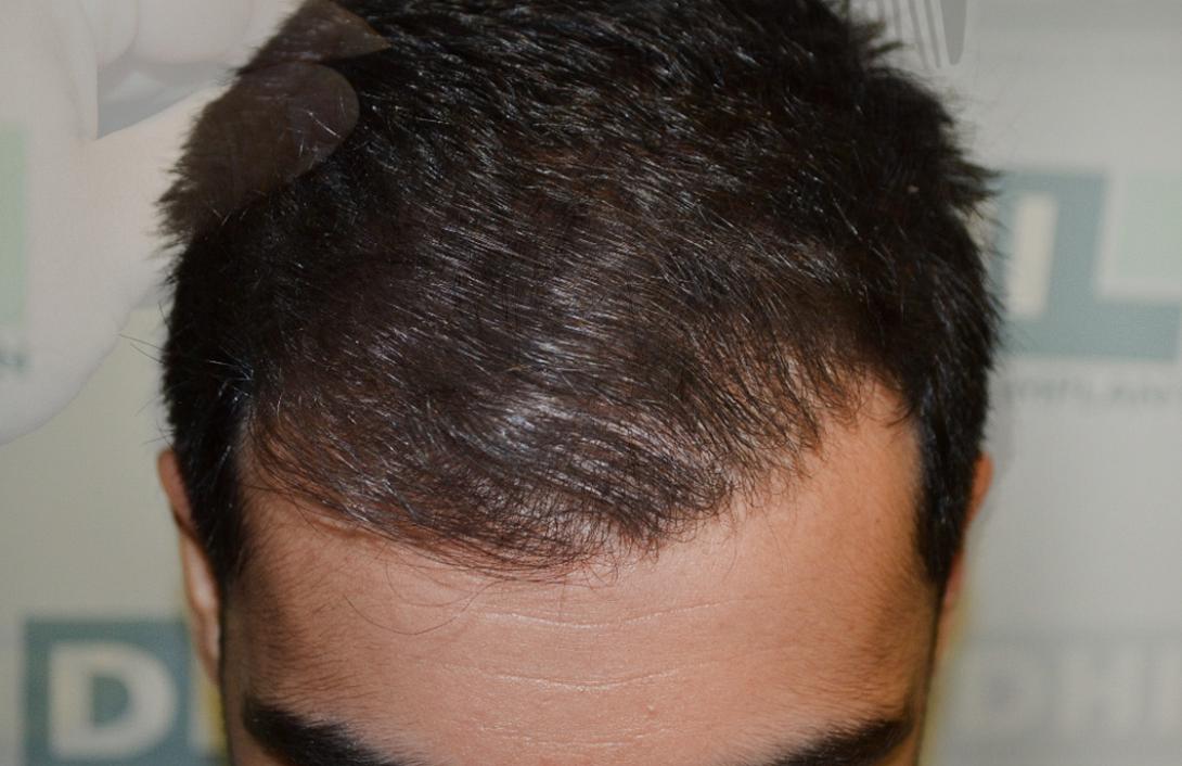after-hair-implantation1.jpg