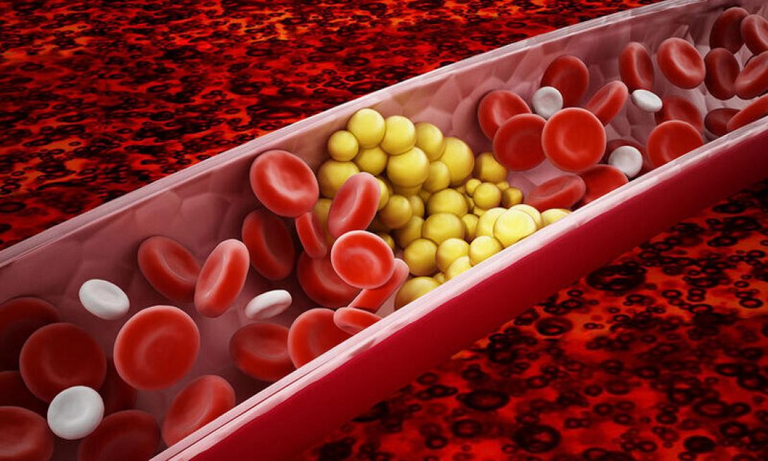 Χοληστερόλη