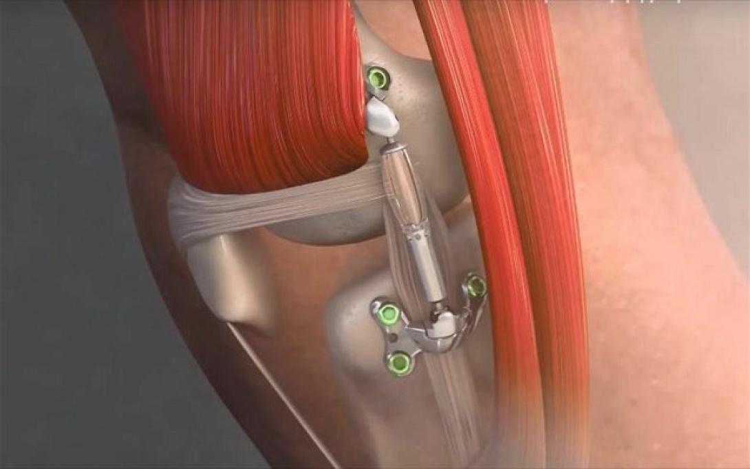 calypso-knee-system.jpg