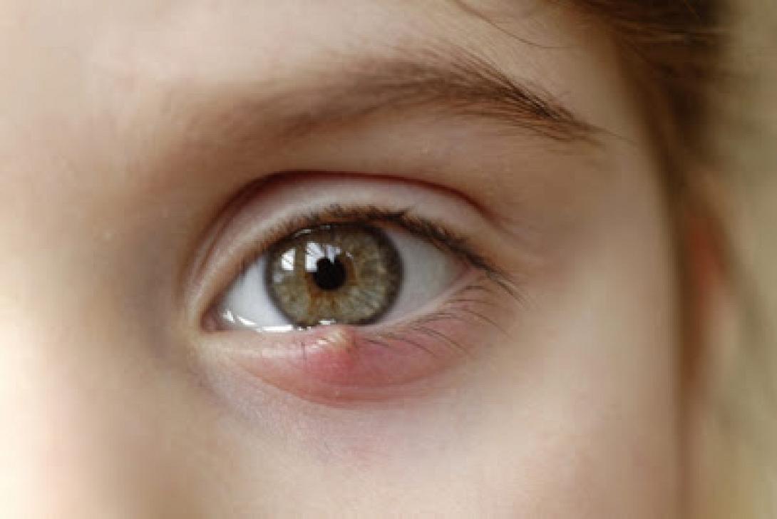 chalazion.jpg