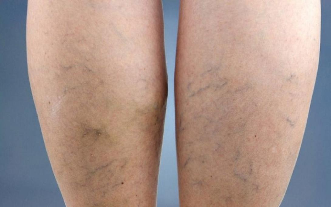 φλεβική θρόμβωση