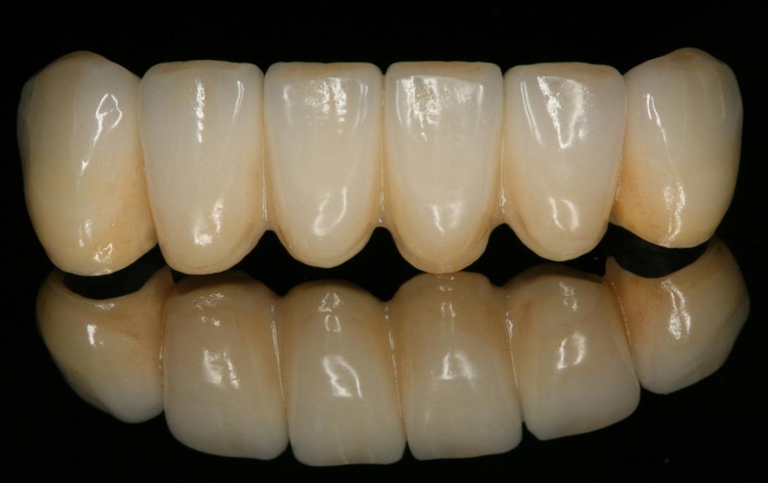 οδοντιατρική γέφυρα