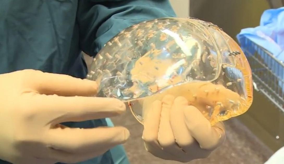 Βίντεο από την πρώτη ολική μεταμόσχευση «εκτυπωμένου» κρανίου παγκοσμίως