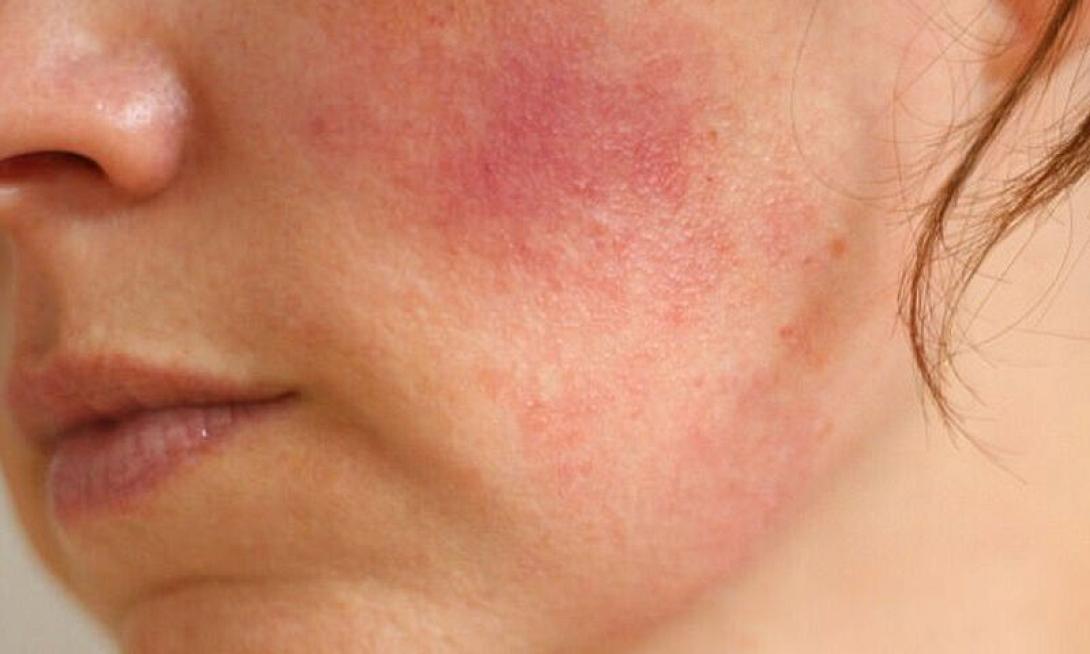 Ερυθηματώδης Λύκος