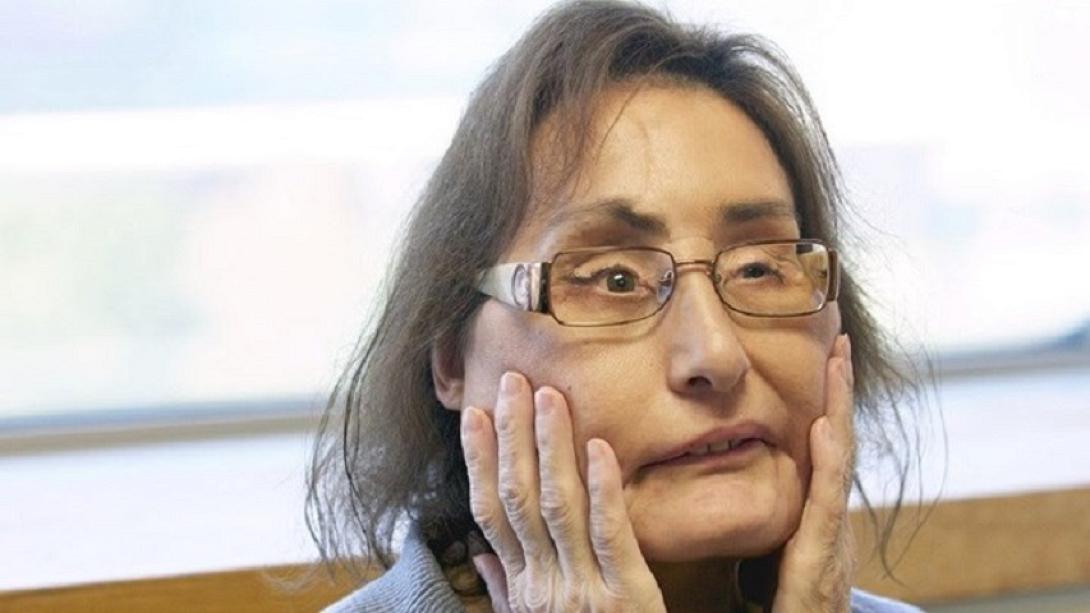 Γυναίκα - μεταμόσχευση προσώπου