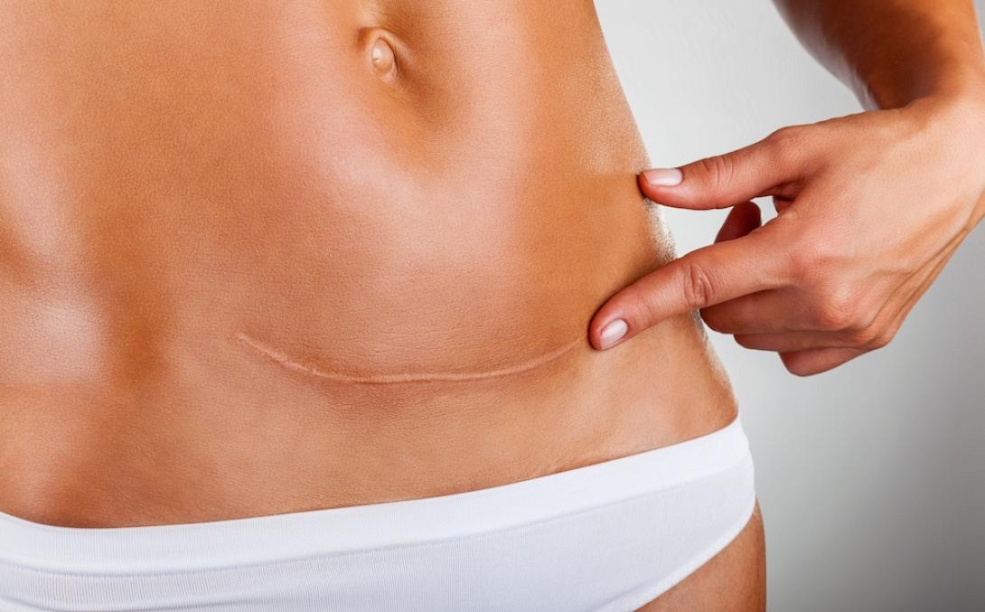 minimizing_c_section_scars.jpg