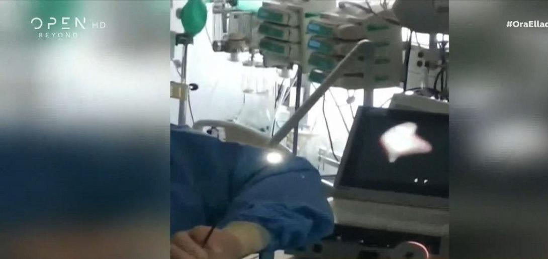  γιατροί έσωσαν μωρό που κατάπιε καρύδι 
