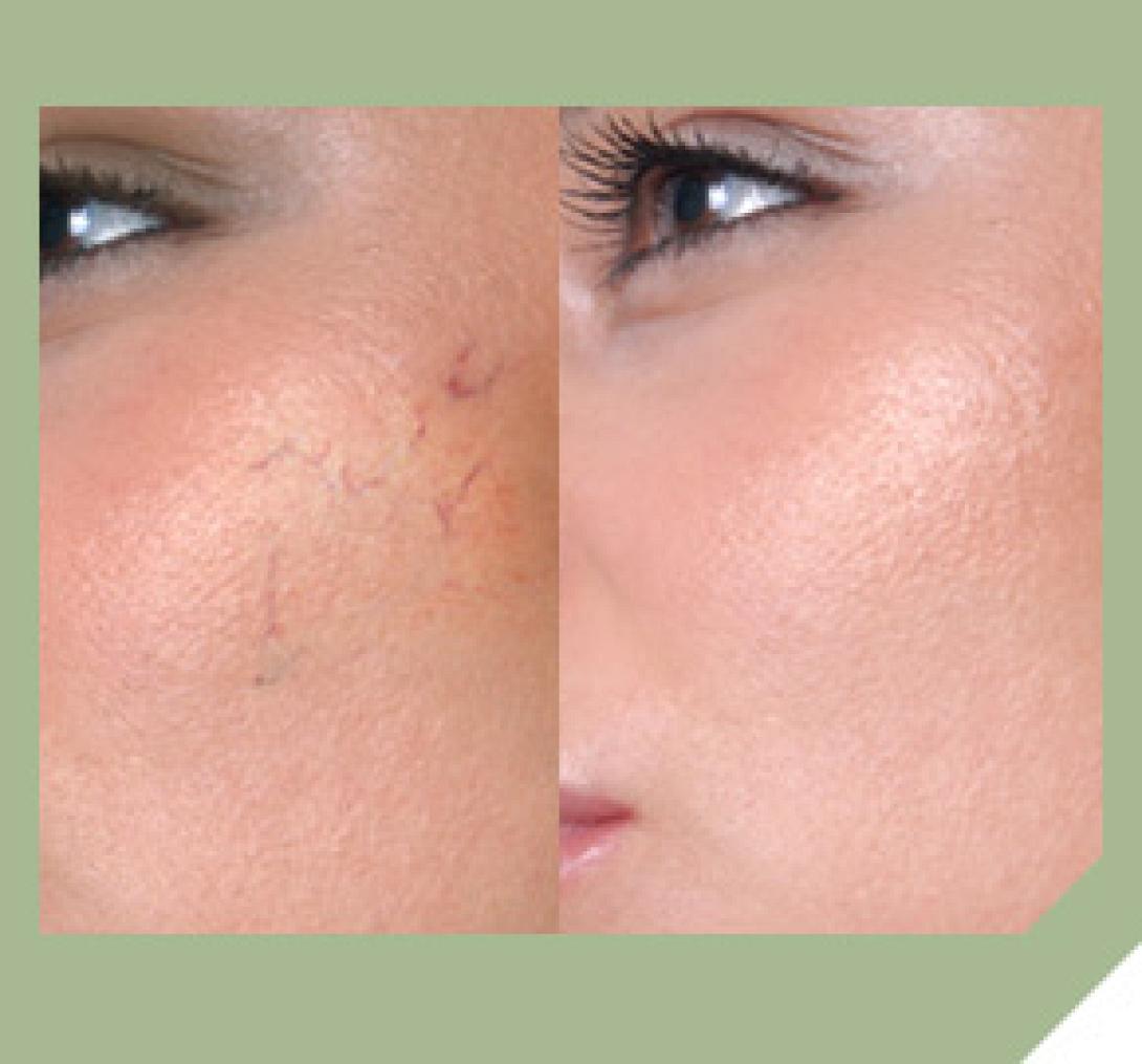 Αντιμετωπίστε με φυσικές μάσκες τις ευρυαγγείες προσώπου